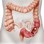 Colorectal Cancer