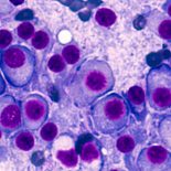Bone Marrow Aspirate Cytology Of Multiple Myeloma