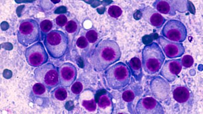 Bone Marrow Aspirate Cytology Of Multiple Myeloma